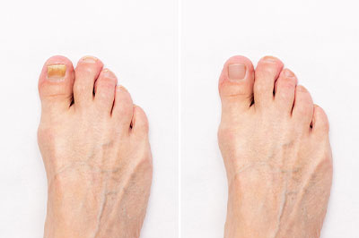 Laser Therapy for Toenail Fungus