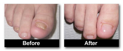 Keryflex™ Nail Restoration System