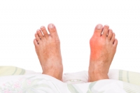 Bunion Treatment