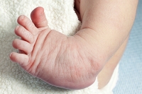 Understanding Club Foot and Its Treatment