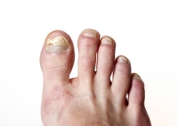 How is Toenail Fungus Diagnosed?