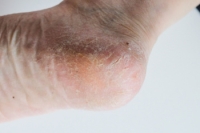 Causes and Podiatric Solutions for Cracked Heels