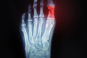 How Runners Manage Broken Toes