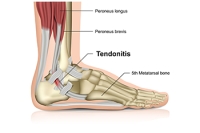 Achilles Tendonitis and How to Find Relief