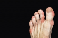 Gout Is More Prevalent Among Men