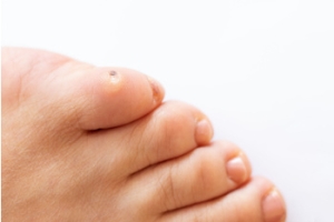 Difference Between Corns and Calluses