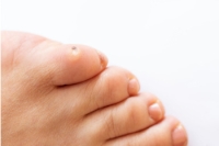 Difference Between Corns and Calluses