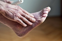 Recognizing Raynaud’s Phenomenon in the Feet